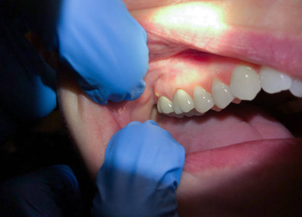 Best Broken or Chipped Tooth Repair in St Paul, NE